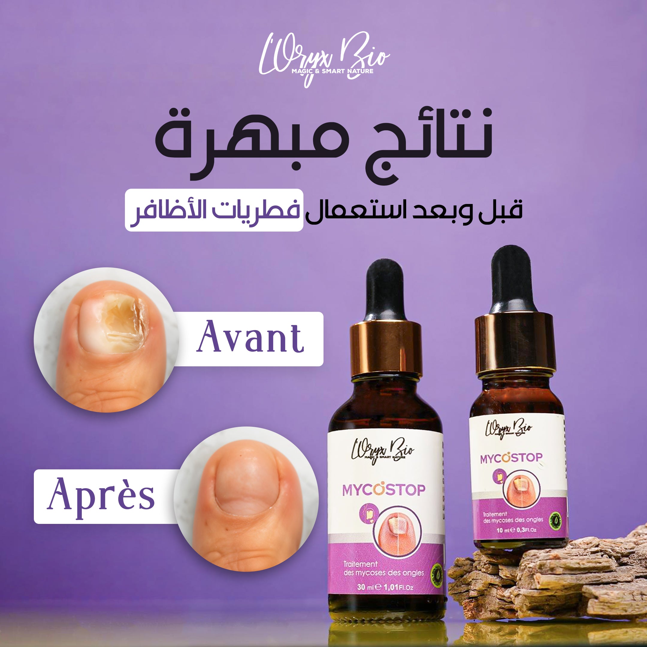 Le Sérum Mycostop est un concentré de 12 plantes puissantes antifongiques, nourrissantes, réparatrices et revitalisantes. Cette formulation unique assure un traitement efficace et rapide pour les mycoses de l’ongle et permet de reconstruire un ongle sain. Ce traitement local permet de soigner efficacement et durablement les mycoses de l’ongle (onychomycose) et évite la propagation de l’infection fongique (les dermatophytes) sur les autres ongles du pied. Elle renforce la fonction barrière de l’ongle et rest