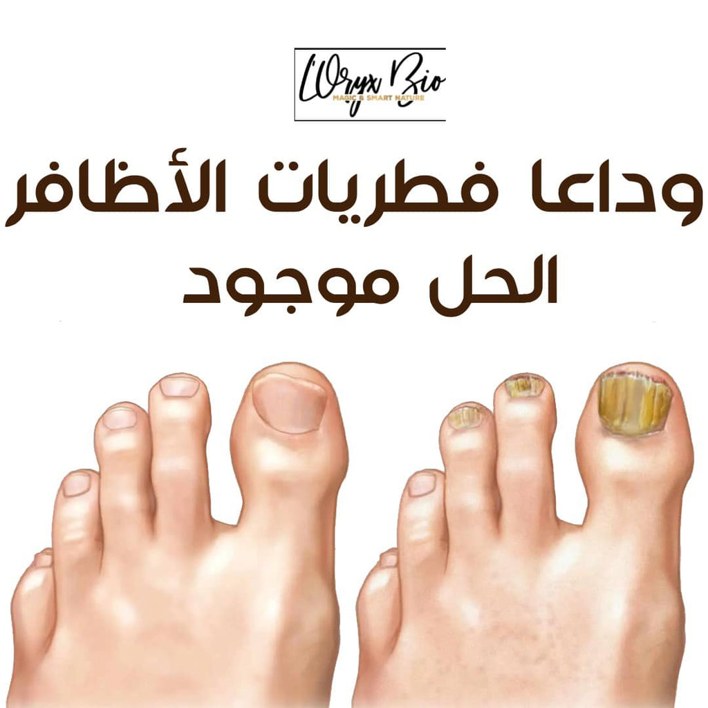 Le Sérum Mycostop est un concentré de 12 plantes puissantes antifongiques, nourrissantes, réparatrices et revitalisantes. Cette formulation unique assure un traitement efficace et rapide pour les mycoses de l’ongle et permet de reconstruire un ongle sain. Ce traitement local permet de soigner efficacement et durablement les mycoses de l’ongle (onychomycose) et évite la propagation de l’infection fongique (les dermatophytes) sur les autres ongles du pied. Elle renforce la fonction barrière de l’ongle et rest